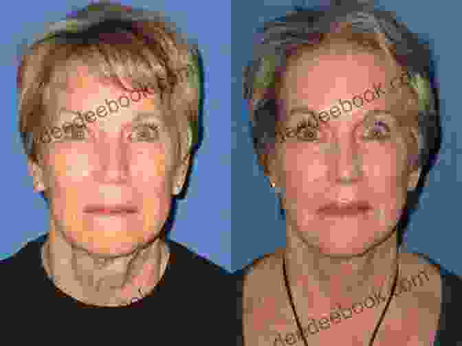 Before And After Facelift Your Complete Guide To Facial Cosmetic Surgery