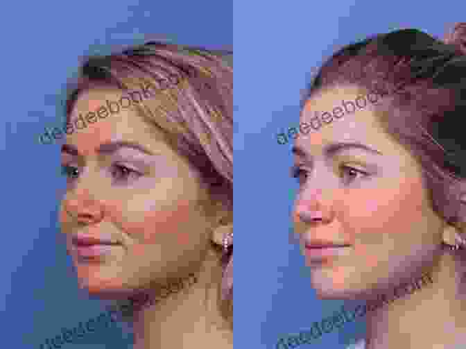 Before And After Rhinoplasty Your Complete Guide To Facial Cosmetic Surgery
